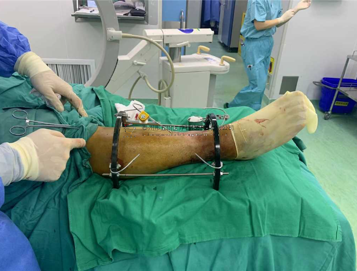 【望京醫(yī)院】不開刀治骨折病例分享——小腿骨折伴踝骨折 【望京醫(yī)院】不開刀治骨折病例分享——小腿骨折伴踝骨折