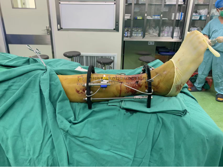 【望京醫(yī)院】不開刀治骨折病例分享——右脛骨遠端骨折 【望京醫(yī)院】不開刀治骨折病例分享——右脛骨遠端骨折