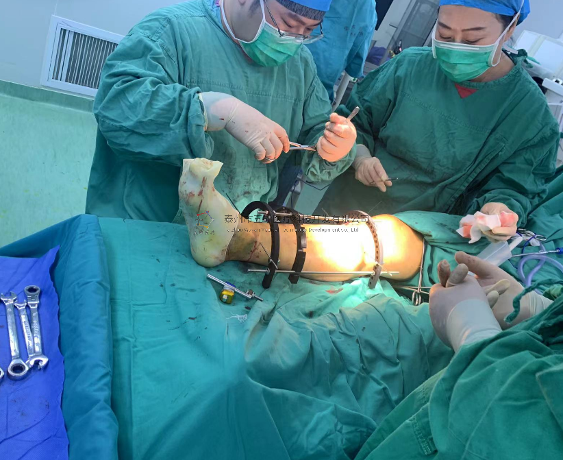 【望京醫(yī)院】不開刀治骨折病例分享——脛骨遠端骨折腓骨骨折 【望京醫(yī)院】不開刀治骨折病例分享——脛骨遠端骨折腓骨骨折