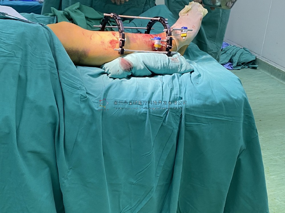 【望京醫(yī)院】不開刀治骨折病例分享——下肢骨折 【望京醫(yī)院】不開刀治骨折病例分享——下肢骨折